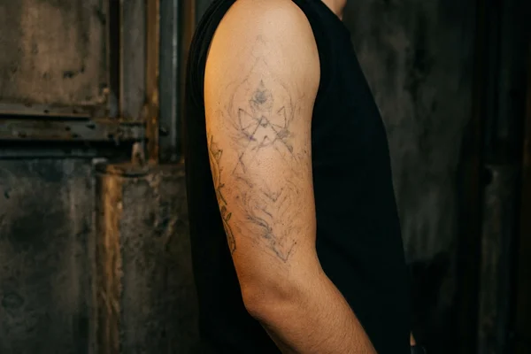 The same arm with ink almost entirely cleared after a full PicoWay course